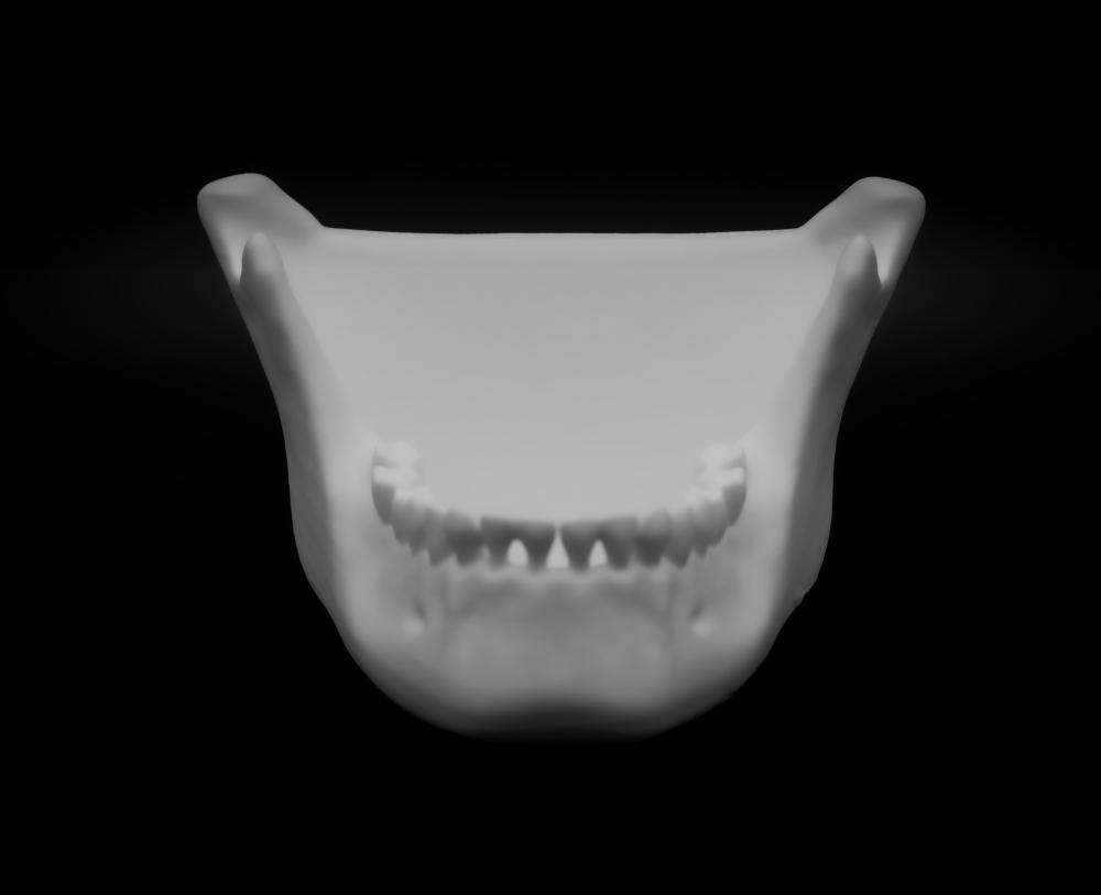 Human Jaw bowl (Pre Supported) 3d model