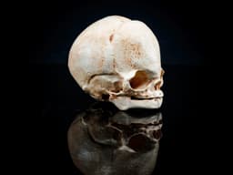 Fetal Skull with Craniosynostosis (Pre Supported) 3d model