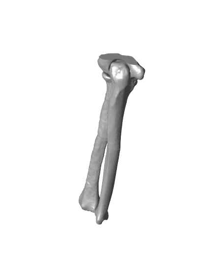 Malunion forearm radial coronal 10 degrees.stl 3d model